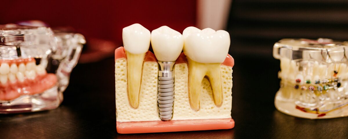 Common Myths About Dental Implants