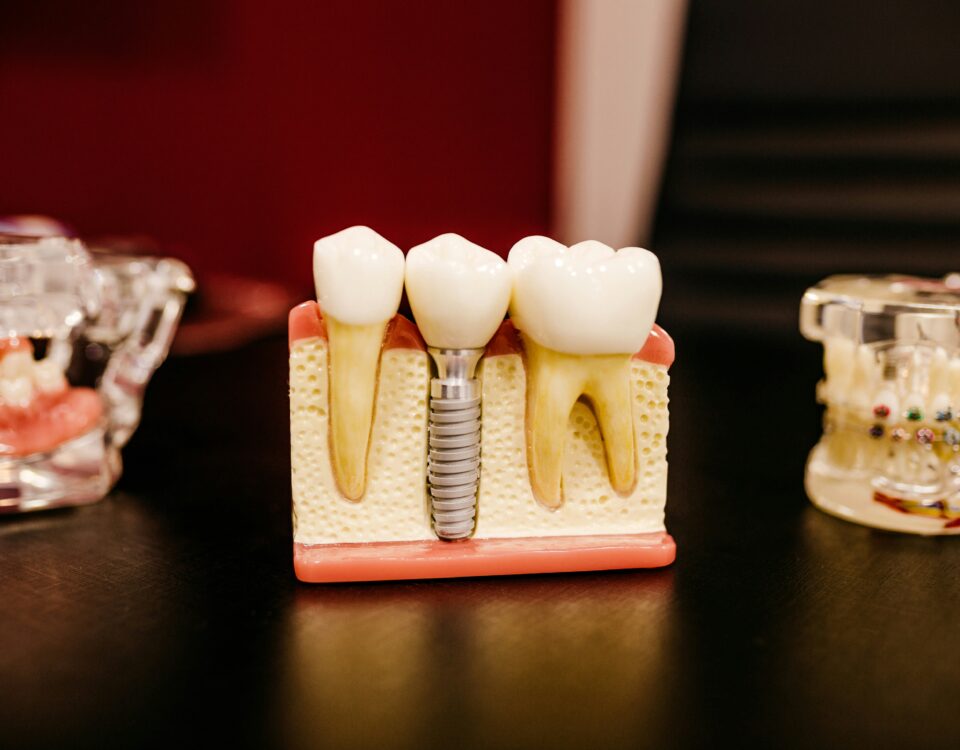 Common Myths About Dental Implants